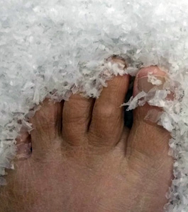 Pijnlijke wintertenen Pijnlijke wintertenen