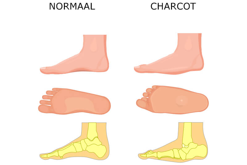 Charcot voet