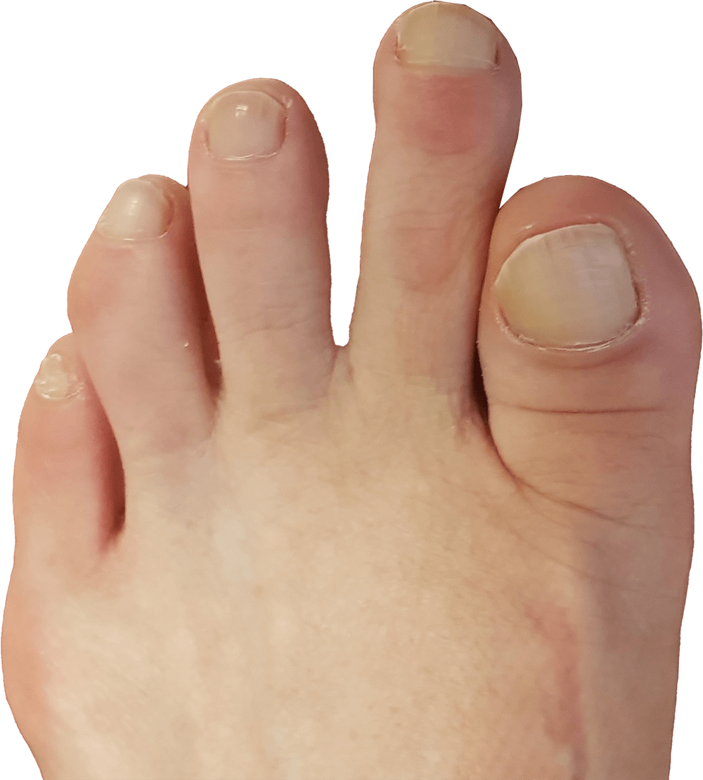 Voorbeeld van een voet waarbij de tweede teen langer is dan de grote teen.